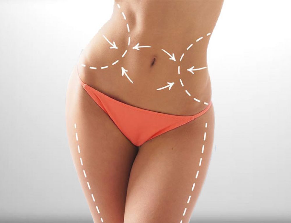 liposuction-500x383@2x